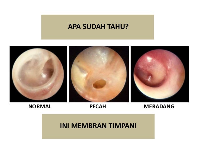 TRAUMA TELINGA Ear Trauma 