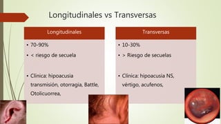 Longitudinales vs Transversas
Longitudinales
• 70-90%
• < riesgo de secuela
• Clínica: hipoacusia
transmisión, otorragia, Battle,
Otolicuorrea,
Transversas
• 10-30%
• > Riesgo de secuelas
• Clínica: hipoacusia NS,
vértigo, acufenos,
 