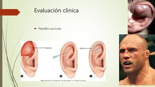 Evaluación clínica
 Pabellón auricular
 