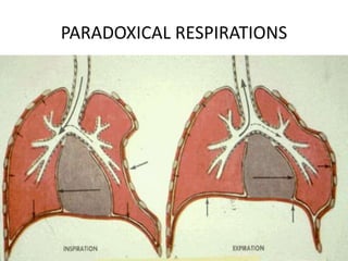 PARADOXICAL RESPIRATIONS
 