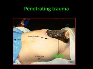 Shell Splinter Wound TRAUMA THORAKS DR TAW RSPAD1.ppt