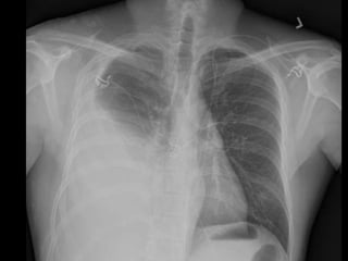 TRAUMA THORAKS DR TAW RSPAD1.ppt