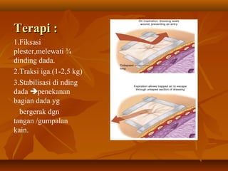 Terapi :
1.Fiksasi
plester,melewati ¾
dinding dada.
2.Traksi iga.(1-2,5 kg)
3.Stabilisasi di nding
dada penekanan
bagian dada yg
bergerak dgn
tangan /gumpalan
kain.

 