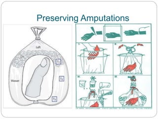 Preserving Amputations
 