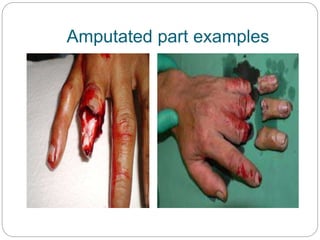 Amputated part examples
 