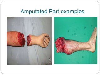 Amputated Part examples
 