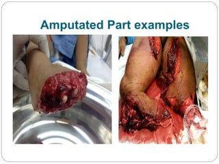 Amputated Part examples
 