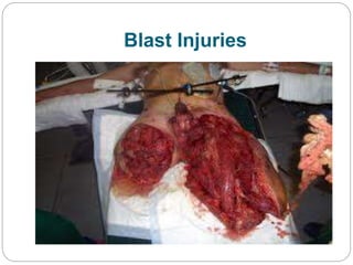 Blast Injuries
 