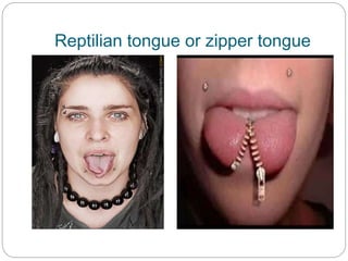 Reptilian tongue or zipper tongue
 
