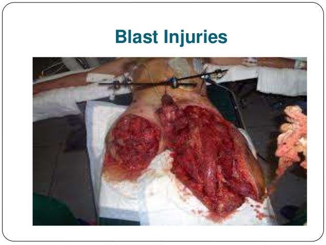Traumatic Amputations