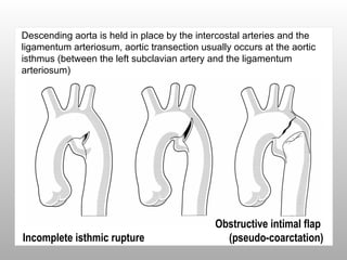 Incomplete isthmic rupture
Obstructive intimal flap
(pseudo-coarctation)
Descending aorta is held in place by the intercostal arteries and the
ligamentum arteriosum, aortic transection usually occurs at the aortic
isthmus (between the left subclavian artery and the ligamentum
arteriosum)
 
