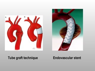 Tube graft technique Endovascular stent
 
