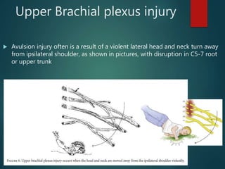 Upper Brachial plexus injury
 Avulsion injury often is a result of a violent lateral head and neck turn away
from ipsilateral shoulder, as shown in pictures, with disruption in C5-7 root
or upper trunk
 