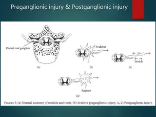 Preganglionic injury & Postganglionic injury
 