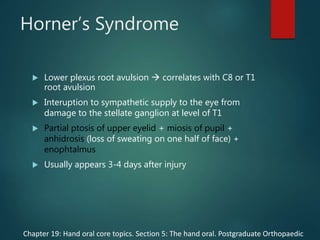 Horner’s Syndrome
 Lower plexus root avulsion  correlates with C8 or T1
root avulsion
 Interuption to sympathetic supply to the eye from
damage to the stellate ganglion at level of T1
 Partial ptosis of upper eyelid + miosis of pupil +
anhidrosis (loss of sweating on one half of face) +
enophtalmus
 Usually appears 3-4 days after injury
Chapter 19: Hand oral core topics. Section 5: The hand oral. Postgraduate Orthopaedic
 