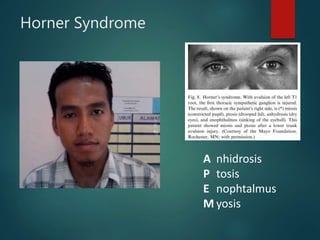 Horner Syndrome
A
P
E
M
nhidrosis
tosis
nophtalmus
yosis
 