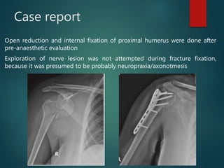 Case report
Open reduction and internal fixation of proximal humerus were done after
pre-anaesthetic evaluation
Exploration of nerve lesion was not attempted during fracture fixation,
because it was presumed to be probably neuropraxia/axonotmesis
 
