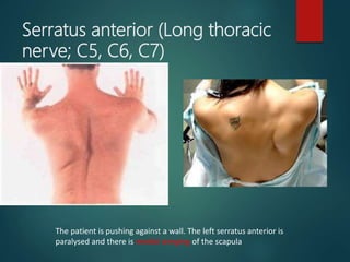 Serratus anterior (Long thoracic
nerve; C5, C6, C7)
The patient is pushing against a wall. The left serratus anterior is
paralysed and there is medial winging of the scapula
 
