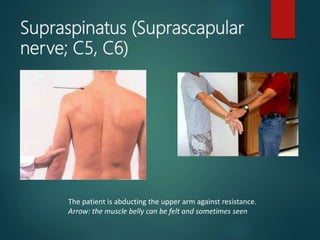Supraspinatus (Suprascapular
nerve; C5, C6)
The patient is abducting the upper arm against resistance.
Arrow: the muscle belly can be felt and sometimes seen
 