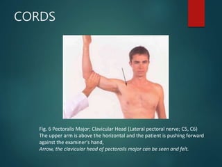 CORDS
Fig. 6 Pectoralis Major; Clavicular Head (Lateral pectoral nerve; C5, C6)
The upper arm is above the horizontal and the patient is pushing forward
against the examiner's hand,
Arrow, the clavicular head of pectoralis major can be seen and felt.
 