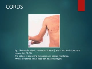 CORDS
Fig. 7 Pectoralis Major: Sternocostal Head {Lateral and medial pectoral
nerves; C6, C7,C8)
The patient is adducting the upper arm against resistance.
Arrow: the sterno-costal head can be seen and felt.
 
