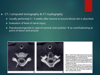  CT / computed tomography & CT myelography
 Usually performed 3 – 4 weeks after trauma to ensure blood clot is absorbed
 Evaluation of level of nerve injury
 Pseudomeningocele in case of cervical root avulsion  as overshadowing at
point of lesion and around
 