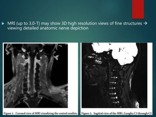  MRI (up to 3.0-T) may show 3D high resolution views of fine structures 
viewing detailed anatomic nerve depiction
 