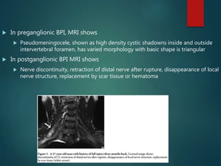  In preganglionic BPI, MRI shows
 Pseudomeningocele, shown as high density cystic shadowns inside and outside
intervertebral foramen, has varied morphology with basic shape is triangular
 In postganglionic BPI MRI shows
 Nerve discontinuity, retraction of distal nerve after rupture, disappearance of local
nerve structure, replacement by scar tissue or hematoma
 