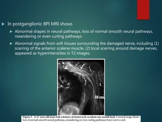  In postganglionic BPI MRI shows
 Abnormal shapes in neural pathways, loss of normal smooth neural pathways,
meandering or even curling pathways
 Abnormal signals from soft tissues surrounding the damaged nerve, including (1)
scarring of the anterior scalene muscle, (2) local scarring around damage nerves,
appeared as hyperintensities in T2 images.
 