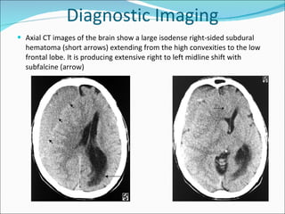Traumatic brain injury Slide 19