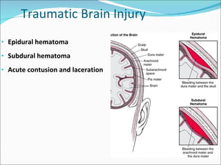 Traumatic brain injury Slide 2