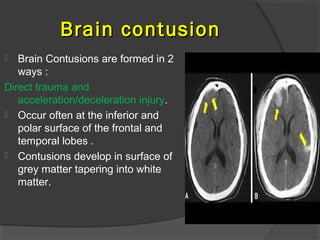 Traumatic brain injury | PPT