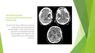 Perimesencephalic
nonaneurysmal subarachnoid
hemorrhage
Head CT of three different patients
demonstrating subarachnoid
hemorrhage in the characteristic
pattern of perimesencephalic
hemorrhage with blood in the
interpeduncular and ambient
cisterns.
 