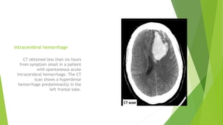 intracerebral hemorrhage
CT obtained less than six hours
from symptom onset in a patient
with spontaneous acute
intracerebral hemorrhage. The CT
scan shows a hyperdense
hemorrhage predominantly in the
left frontal lobe.
 