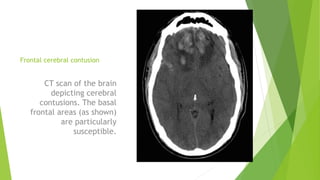 Frontal cerebral contusion
CT scan of the brain
depicting cerebral
contusions. The basal
frontal areas (as shown)
are particularly
susceptible.
 
