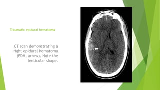 Traumatic epidural hematoma
CT scan demonstrating a
right epidural hematoma
(EDH, arrow). Note the
lenticular shape.
 