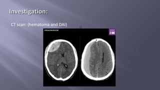 Traumatic brain injury | PPTX