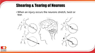 Shearing & Tearing of Neurons
• When an injury occurs the neurons stretch, twist or
tear.
 