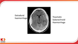 Extradural
haemorrhage
Traumatic
Subarachnoid
Haemorrhage
 