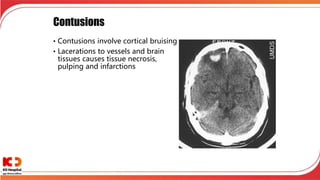 Contusions
• Contusions involve cortical bruising
• Lacerations to vessels and brain
tissues causes tissue necrosis,
pulping and infarctions
 