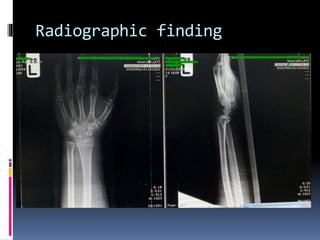 Radiographic finding
 