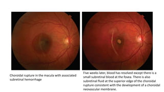 Choroidal rupture in the macula with associated
subretinal hemorrhage
Five weeks later, blood has resolved except there is a
small subretinal blood at the fovea. There is also
subretinal fluid at the superior edge of the choroidal
rupture consistent with the development of a choroidal
neovascular membrane.
 