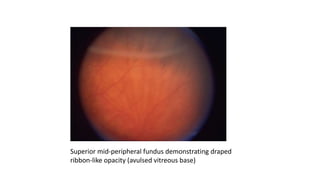 Superior mid-peripheral fundus demonstrating draped
ribbon-like opacity (avulsed vitreous base)
 