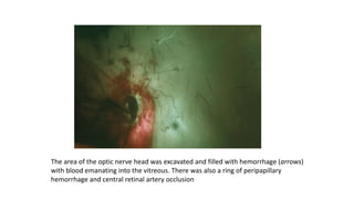 The area of the optic nerve head was excavated and filled with hemorrhage (arrows)
with blood emanating into the vitreous. There was also a ring of peripapillary
hemorrhage and central retinal artery occlusion
 