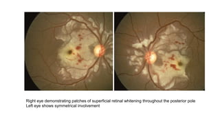 Right eye demonstrating patches of superficial retinal whitening throughout the posterior pole
Left eye shows symmetrical involvement
 