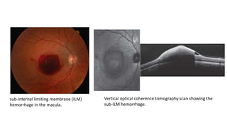 sub-internal limiting membrane (ILM)
hemorrhage in the macula.
Vertical optical coherence tomography scan showing the
sub-ILM hemorrhage.
 
