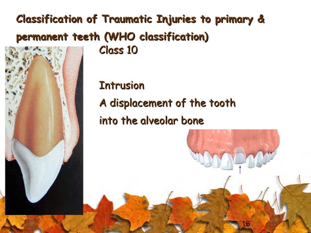 Classification of traumatic Injuries to anterior teeth of children | PPT