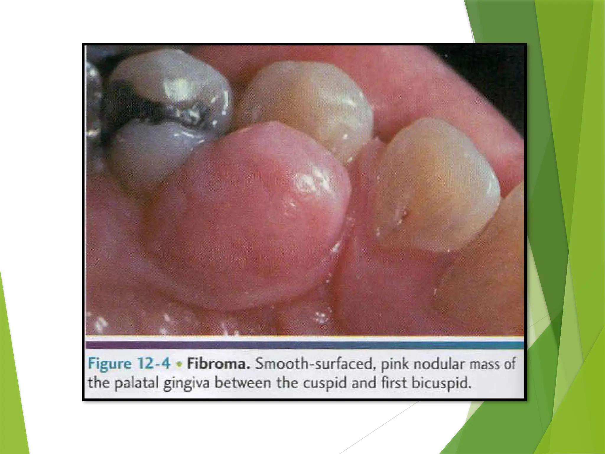 traumatic fibroma due to sharp cusp.pptx