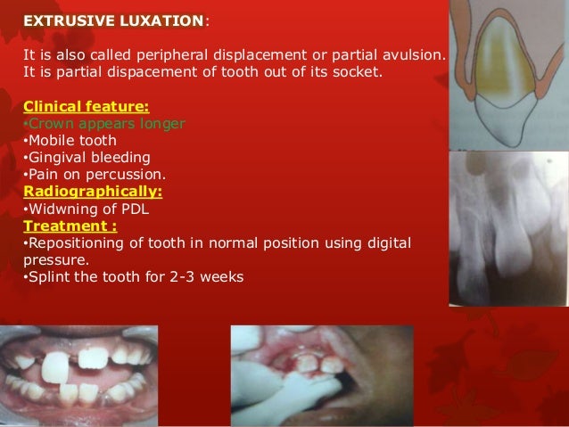 tooth luxation