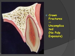  Crown
Fractures
—
Uncomplica
ted
(No Pulp
Exposure)
 